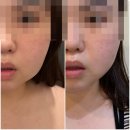 제일피부관리 | 화곡동피부관리 윤곽관리 받고 온 후기 제일에스테틱 화곡역점