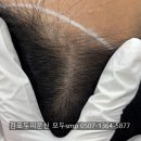 라인헤어 | 일산헤어라인문신 내돈내산후기