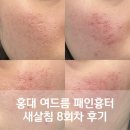 8 | 홍대 여드름 패인흉터 새살침 8회차 후기