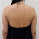 멍스타일 | 팔뚝 무한람스 당일~한달 찐 후기(멍·통증·흉터·후관리·가격)