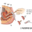 자궁경부암 검사 반응성 세포 HPV 자궁이형성증 이미지