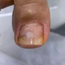 레푸스&아트포레 | 부산 무좀발톱·내성발톱 관리 후기｜해운대 레푸스&amp;아트포레