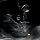 임신일기 #2 :: 산본제일병원 주차별 기록, 베이비페이스, 젠더리빌 파티(기형아검사, 취약 x증후군...