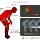 파킨슨병 이미지