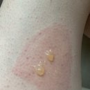 도담외과의원 | 에어프라이기 화상치료 후기 잠실 화상전문병원 삼성서울도담외과의원