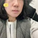 [쌍문연세애드미피부과] 리팟레이저로 검버섯 제거완료^^ 리얼 후기!!