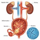대인제통마취통증의학과의원 | 방광염 약 먹어도 며칠 뒤 또?약국 약과 자연치료의 한계