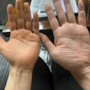 손바닥에 생긴 "이 증상" 그냥 넘기지 마세요 췌장암 초기 찾아온 겁니다. 이미지