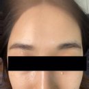 르노삼성자동차수성점 | 수성구 깔끔한 비립종 압출 후기 프레야뷰티