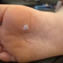 리센츠약국 | 아이 발 사마귀 재발… 이번엔 베루말액으로 집에서 치료 시작!