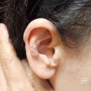 귀로 보는 건강클리닉 이혈 | 이혈테라피 귀지압패치 이혈기석 집에서 사용해요