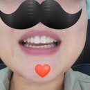 뷰티앤디지털치과병원 | 아이 리쥬란 시술 후기 및 왜소치로 인한 라미네이트 후기 (내돈내산)
