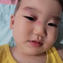 18개월 아기 피부 상처(눈 위 찢어짐)/일산병원 응급실/자이언 성형외과에서 봉합 후기