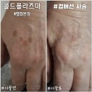 콜드플라즈마 이미지