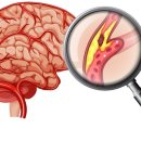 가공식품 성분표 잘 살피면 뇌졸중 위험 61% 감소 이미지