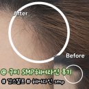 구미 산동 두피 헤어라인 SMP 리터치 후기 탈모 머리숱보강 프롬더봄 갓스칼프