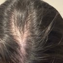 강남-120 | [서울 강남] 맥스웰피부과의원 강남점 / 2년만에 다시 치료 시작! / W3 프로그램 후기 /