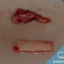 김진걸치과의원 | [판교치과] 잇몸이식수술 종류