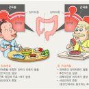 대장 게실증 원인 증상 치료 게실염 원인 증상 합병증 대장게실증과 게실염 차이 이미지