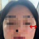 홍승업성형외과 | 홍승업 성형외과 상담후기 내돈내산