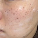 순한의원 | 루비레이저 2주차 후기, 내돈내산, 루나의원 루비레이저