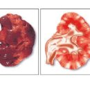 급성 만성 신우신염 원인 방법 이미지