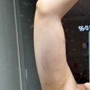 제일커뮤니케이션주 | 대전 둔산동 팔뚝 지방분해주사 후기, 지방분해주사 비용 공유!
