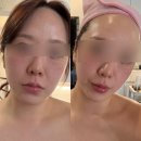 [새솔동] 화성 새솔동 피부관리 귀족리프팅, 속건조피부 후기 : 쁘띠인샵