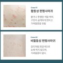 목은한의원 | [전주] 편평사마귀제거 레이저 vs 침 한의원 내돈내산 후기 2주과정