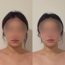 4822 | JH 윤곽술 후기｜붓기 빠지고 턱선 살아난 김포 얼굴윤곽관리