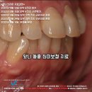 캘리포니아치과의원 | 앞니지르코니아 크라운 2개, 4개, 6개 어떤 모습일까?