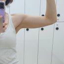 수지로1L | 수지비만클리닉 팔뚝다이어트 제로팻주사 2차 후기