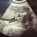 갈지6-29 농로 | 임신 29주 차 증상 아기 크기 빈혈 수치 혈소판감소증 대학병원 전원?