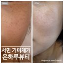 서면 기미잡티제거 온하루뷰티 두번 다녀온 솔직후기