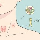 갑상선 결절 의심 증상과 관리 포인트 이미지