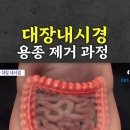 대장 내시경 용종 제거과정보기 // 📚뇌 노화를 늦추는 방법 이미지