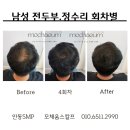 모채움스칼프