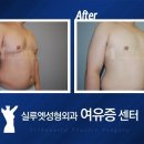 남자 부유방과 여유증 이미지