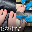 박천수정형외과 | 전주 홀드펀칭 네일제작소 파고드는 내성발톱 관리후기