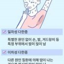 땀이 너무 많이 나요, 땀나는 이유 뭘까? 다한증에 좋은 음식 이미지