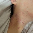 아들딸한의원 | 아토피 한의원 치료 탈스 기록 5 달째 쉽지않다. (잠시 중단 이유)