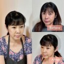 정웅기성형외과 | 강남 압구정 성형외과 스마일 하안검 눈썹하거상술 50대 후기