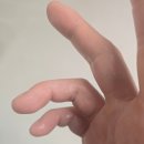 삼성곽재활의학과의원 | 송파 문정역 정형외과 주관증후군? 갑작스러운 갈퀴손 변형.. 손가락저림과 마비