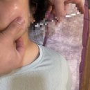 상무한의원 | 상무지구 한의원에서 리프팅 시술 2차 찐후기