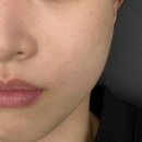 로데오 | 청담피부과 압구정로데오역 리쥬란 내돈내산 후기