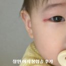 창원파티마병원 | 창원 아기 성형외과 파티마병원 얼굴봉합술 후기