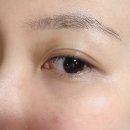 오빗의원 | [압구정 오빗의원] 눈밑 울트라콜200 뭉침 생길까? 결절 걱정하는 분들 필독!!