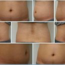 로뎀나무피부비만썬텐 - 동대문구 답십리로 304 | [체험단 후기] 미파문 피부과에서 네오울트라V3 (3주패키지) 1차 받고 왔어요~#1차후기
