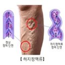 2. 다리부종 예방마사지(정맥류) 이미지