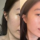 삼성역피부과 포텐자 콜라스터 4회차 후기 스킨부스터추천